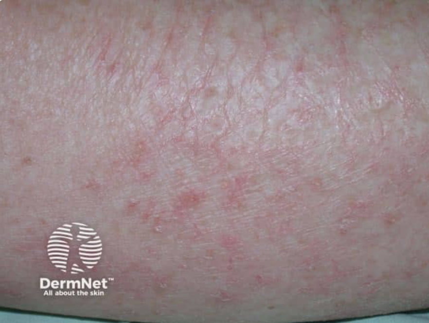 Asteatotic Eczema : Xerosis with mild erythema and fine superficial fissures forming a characteristic reticulated, “cracked” appearance.