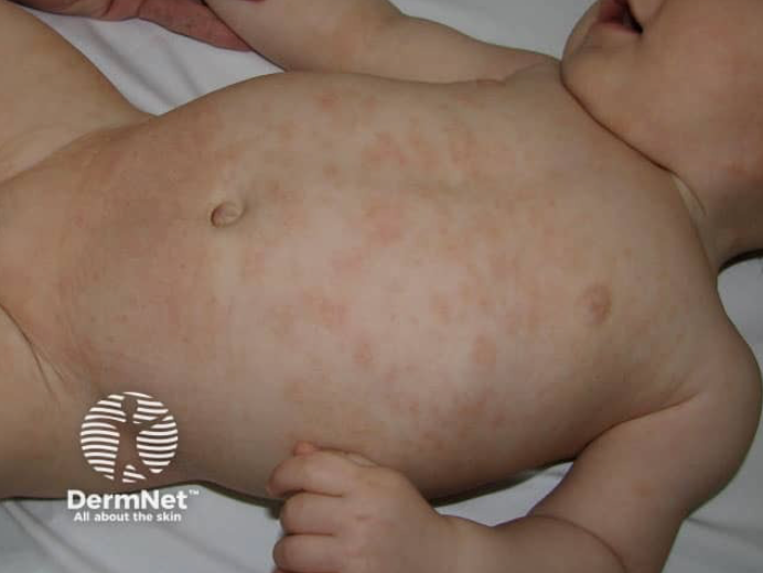 Atopic dermatitis : Multiple faint, poorly demarcated erythematous patches scattered over the trunk.