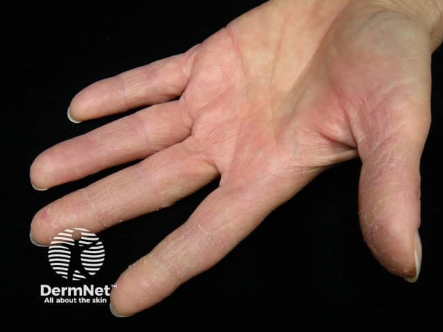 Irritant contact dermatitis : Mild palmar erythema with xerosis and fine scaling, predominantly involving the fingers.