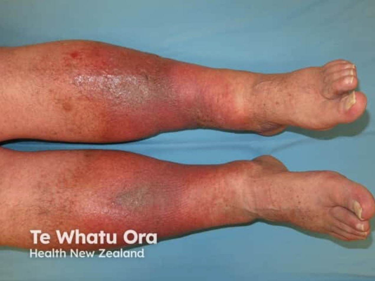 Stasis dermatitis : Bilateral diffuse erythema of the lower legs with marked edema, predominantly involving the distal extremities.