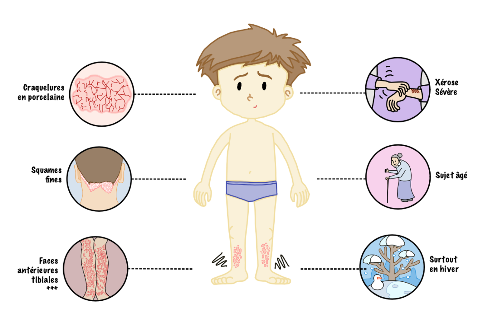 Illustration de l’eczéma astéatotique, caractérisé par une xérose importante avec de fines squames et des fissures en « porcelaine craquelée », touchant préférentiellement les faces antérieures des jambes. La maladie prédomine chez les personnes âgées et