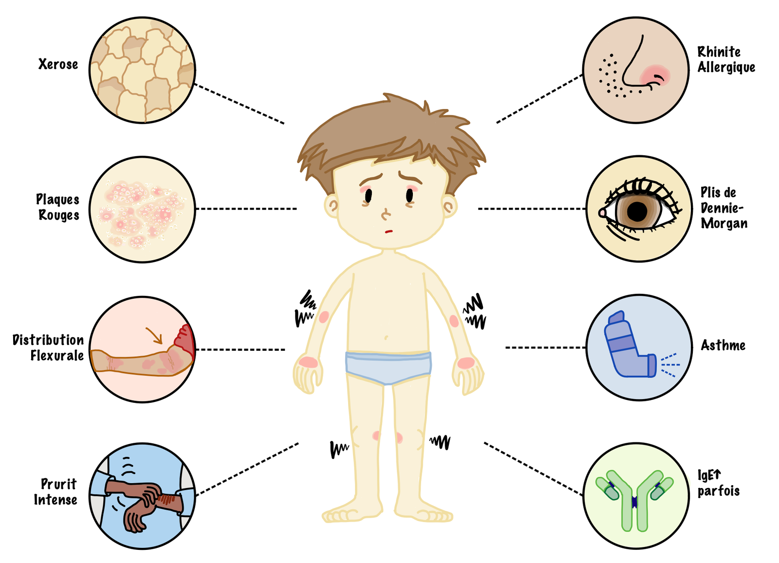llustration of the typical features of atopic dermatitis in a child, including intensely pruritic erythematous plaques, xerosis, and flexural involvement. Associated features of atopy, including asthma, allergic rhinitis, elevated IgE in some patients, an