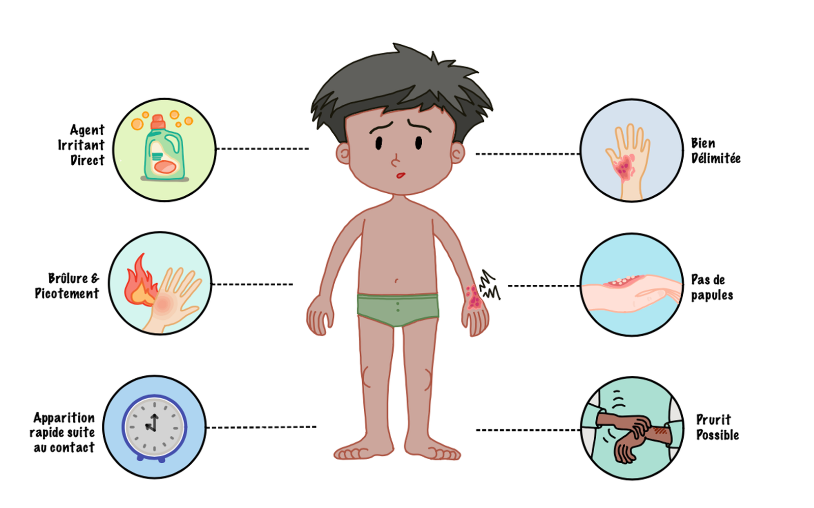 Illustration of typical irritant contact dermatitis, characterized by erythema, dryness, scaling, and sometimes vesicles, bullae, fissures, or erosions, predominantly affecting areas directly exposed to the irritant.