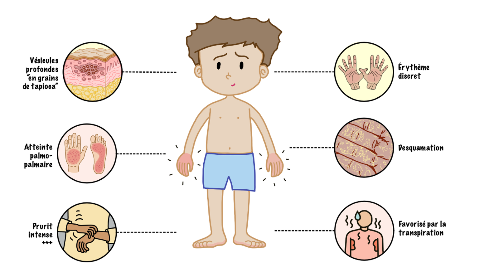 Illustration of the main clinical features of dyshidrotic eczema (pompholyx): deep “tapioca-like” vesicles, palmoplantar involvement, intense pruritus, mild erythema, and scaling during the resolution phase. Flares may be triggered or worsened by heat and