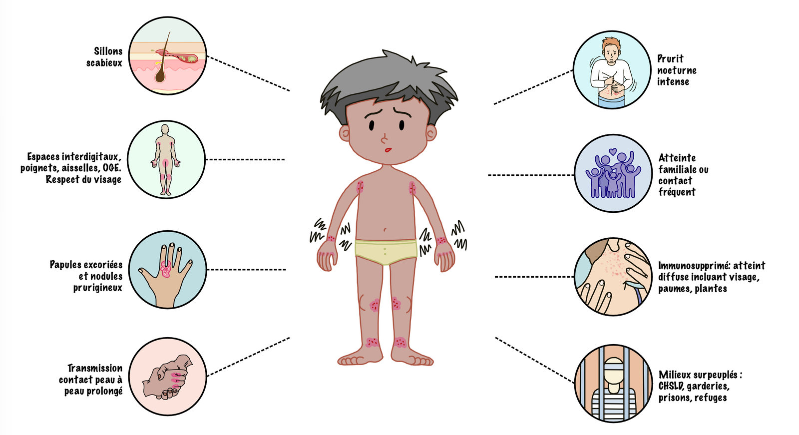 Illustration of the main clinical features of scabies, showing excoriated pruritic papules and nodules together with characteristic scabies burrows, particularly involving the interdigital spaces, wrists, axillae, and genital region, with typical sparing
