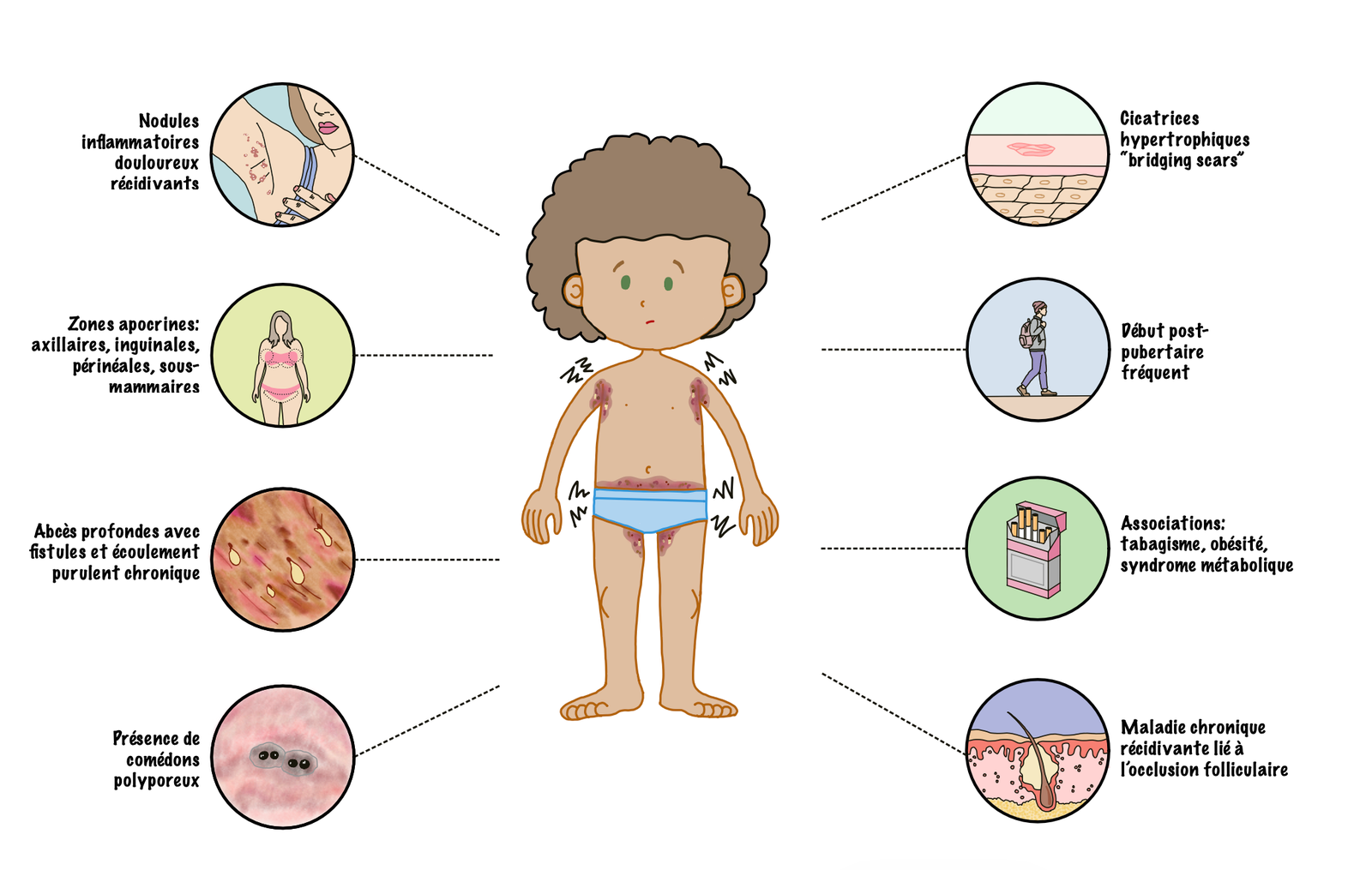 Illustration of the main clinical features of hidradenitis suppurativa, showing recurrent painful inflammatory nodules in typical intertriginous areas, including the axillae, groin, perineal, and inframammary regions. Advanced disease is characterized by