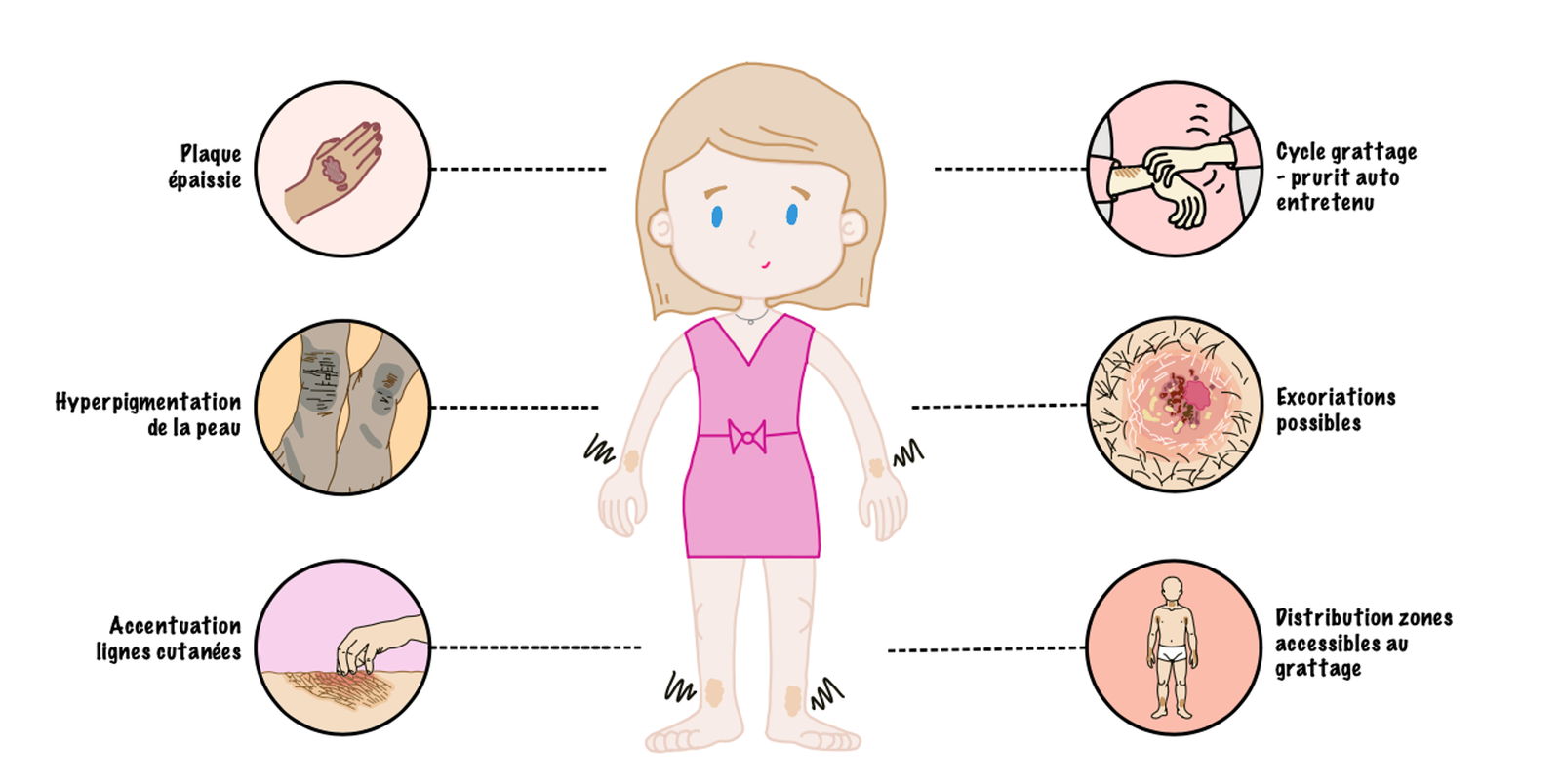 Illustration of the main clinical features of lichen simplex chronicus, including a thickened, lichenified plaque, hyperpigmentation, and accentuation of normal skin markings. The self-perpetuating itch-scratch cycle maintains the condition and may produc