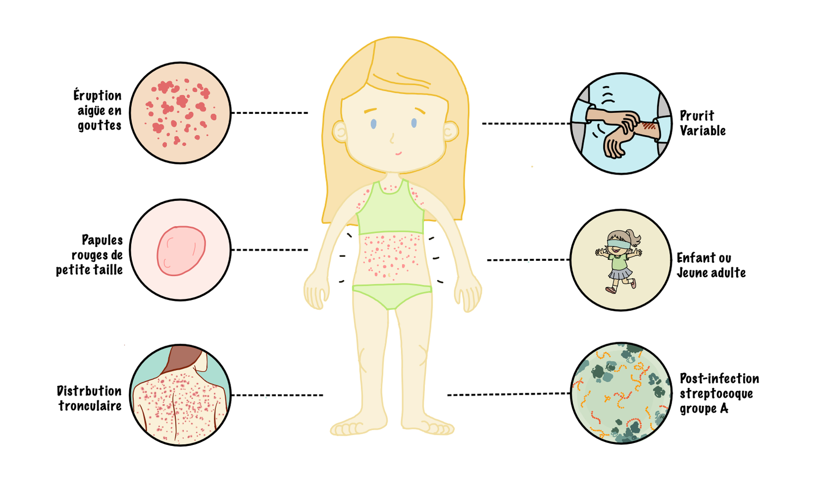 Psoriasis en Gouttes