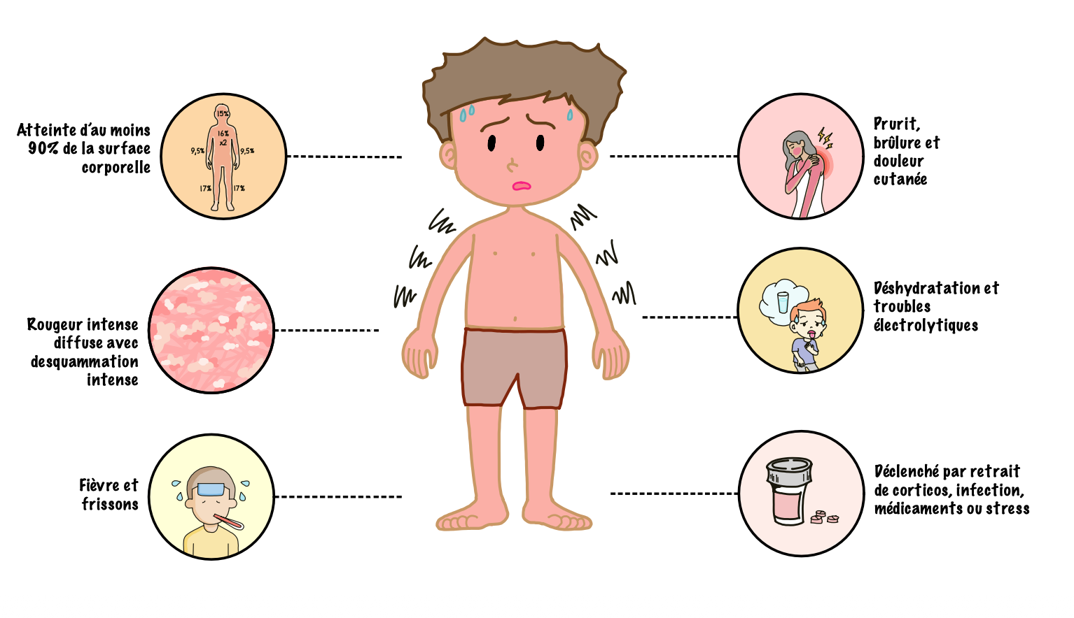 Illustration of erythrodermic psoriasis, characterized by generalized erythema and extensive scaling with potential dehydration, electrolyte disturbances, thermoregulatory dysfunction, and systemic complications.