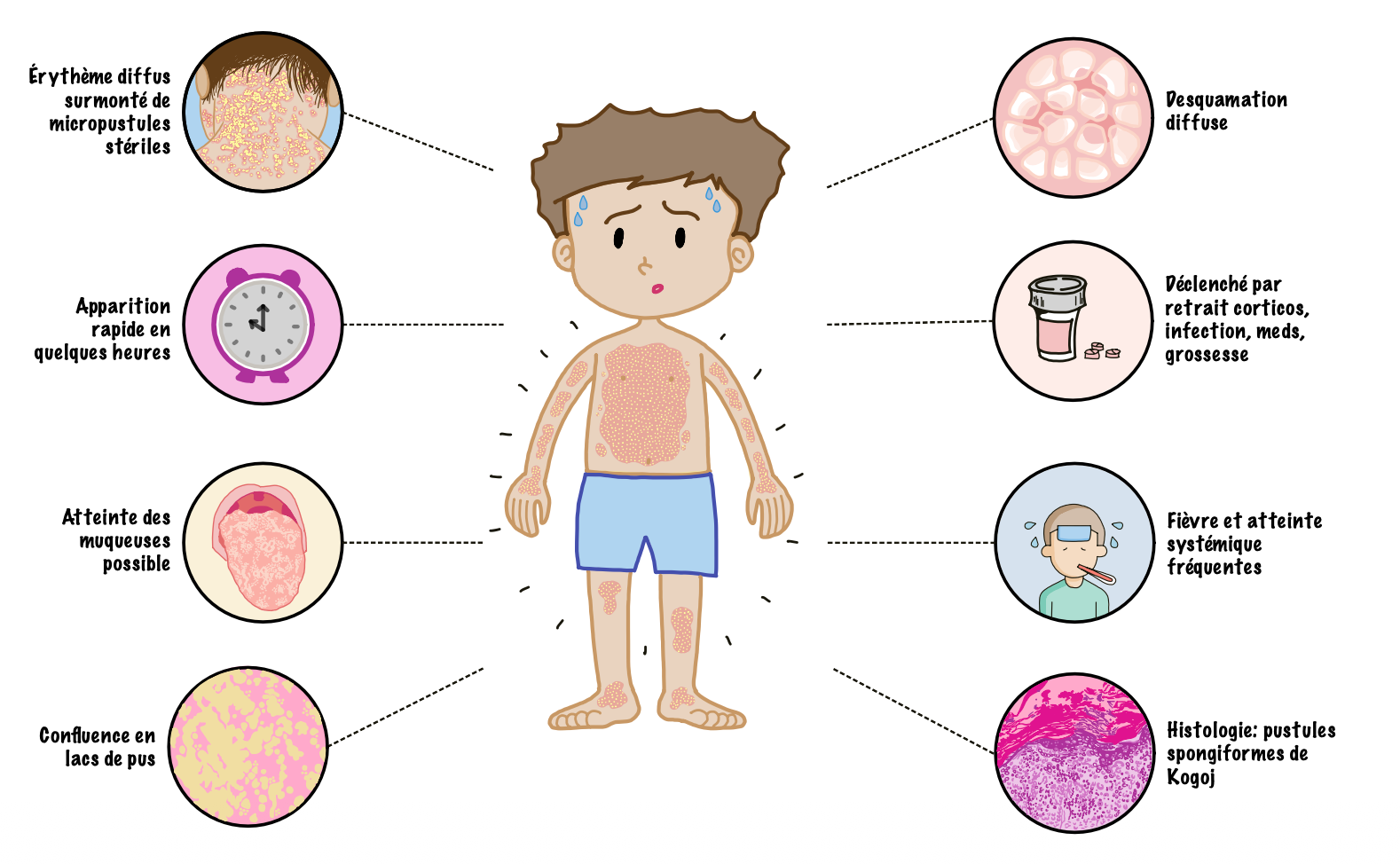 Generalized Pustular Psoriasis